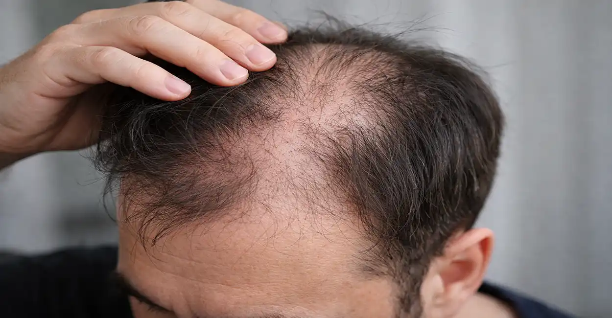 Homem mostrando falhas no couro cabeludo com sinais iniciais de calvície e afinamento dos fios